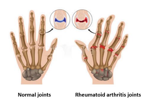 Anti-CCP, eine Signallampe für rheumatoide Arthritis